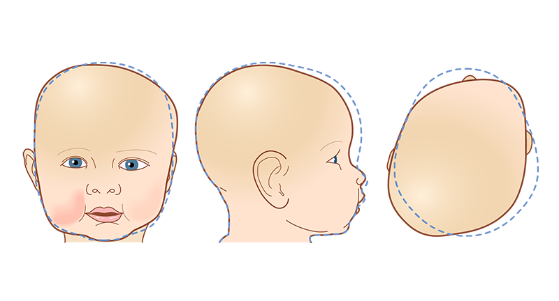 cranial plagiocephaly