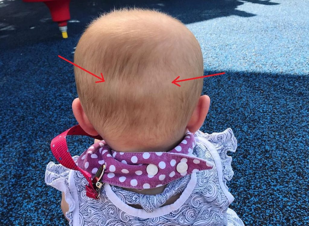 flat spot on infant head