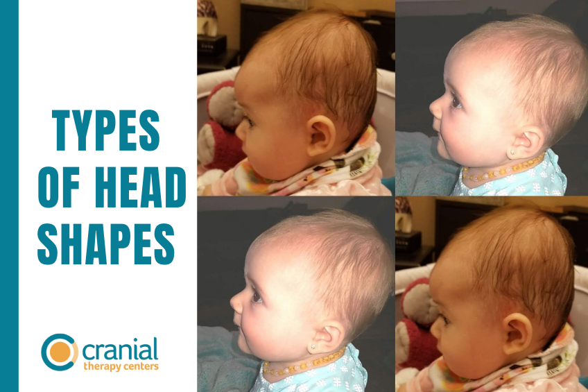 babies-head-shapes-their-consequences-cranial-therapy-centers