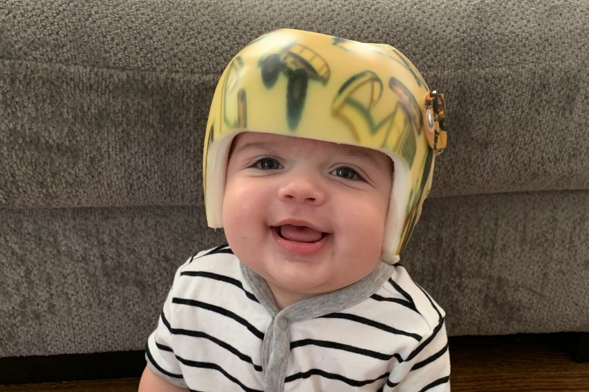 why do some babies wear plastic helmets Temika Andre